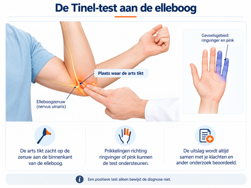 Infographic van de Tinel-test aan de elleboog, met de plaats waar de arts op de elleboogzenuw tikt en het gevoelsgebied van ringvinger en pink.