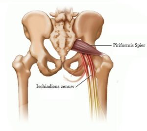 De piriformis spier en de grote beenzenuw in de bil.