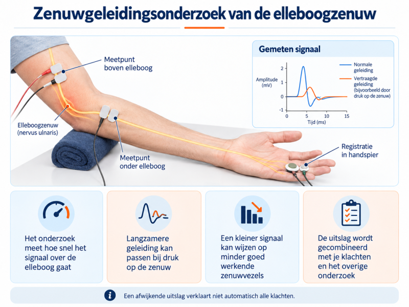 Infographic van een zenuwgeleidingsonderzoek van de elleboogzenuw, met meetpunten boven en onder de elleboog, registratie in de handspier en een voorbeeld van gemeten signalen.