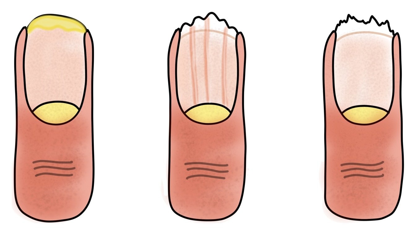 Tekening van drie nagels die splijten of afbrokkelen aan de rand