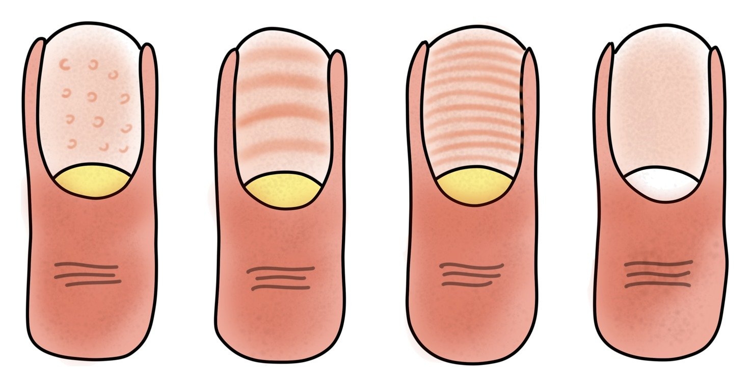 Tekening van vier nagels met witte vlekjes, witte strepen en een helemaal witte nagel