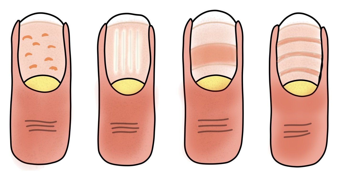Tekening van vier nagels met putjes, ribbels en dwarse groeven
