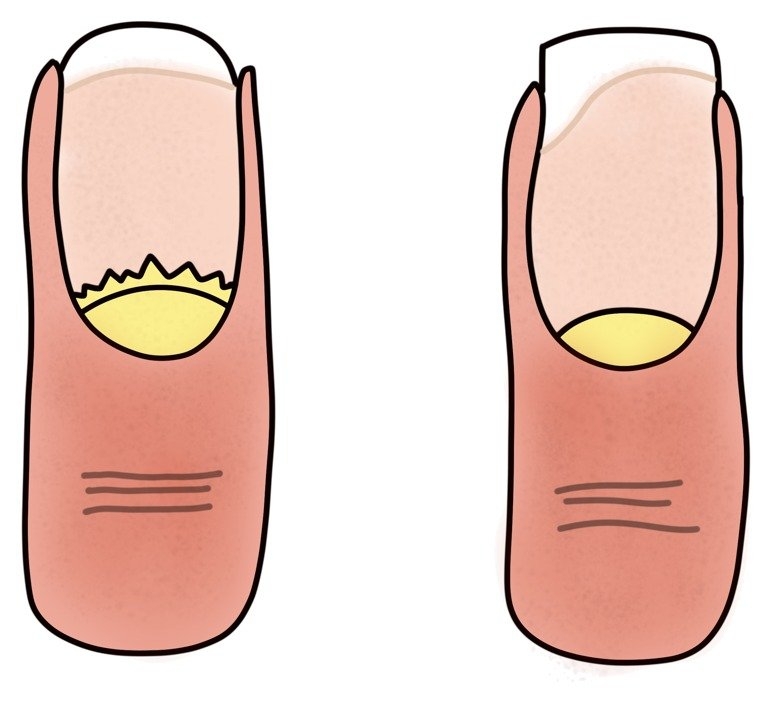 Tekening van twee nagels waarvan de nagelplaat loskomt van het nagelbed