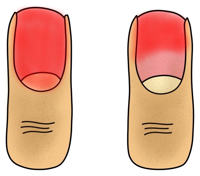 Tekening van twee vingers waarvan de nagel is uitgevallen