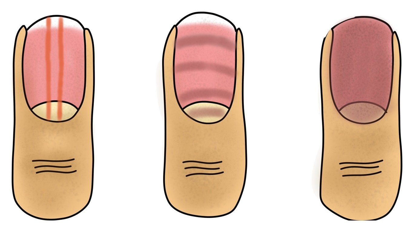 Tekening van drie nagels met donkere strepen, donkere banden en een egaal donkere nagel