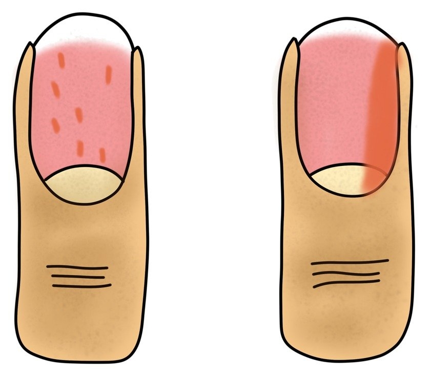 Tekening van twee nagels met rode vlekjes en streepjes onder de nagel