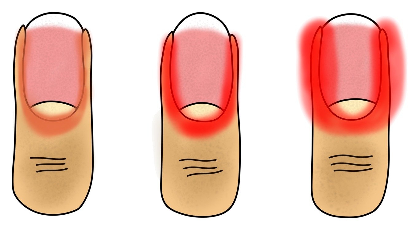 Tekening van drie nagels met een rode, gezwollen nagelwal, van licht tot ernstig