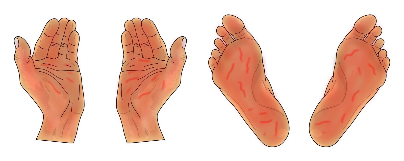 Tekening van handpalmen en voetzolen met kloven