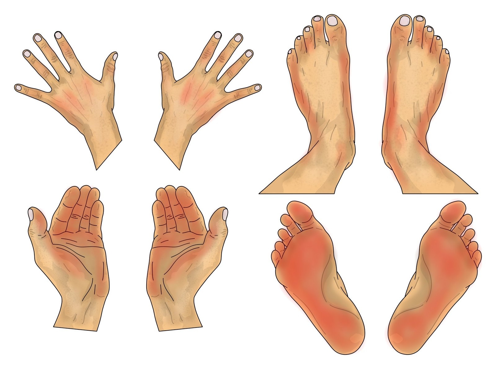 Tekening van handen en voeten met het hand-voetsyndroom graad 1: lichte roodheid van handpalmen en voetzolen
