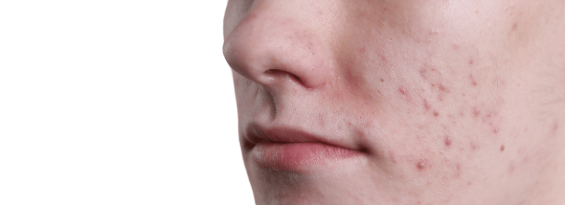 acne gevoelige huid