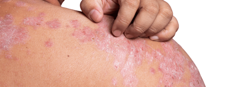 Lichttherapie vergoeding Menzis