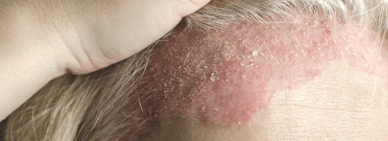 psoriasis capitis