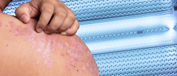 Lichttherapie bij psoriasis: wat vergoedt je zorgverzekering in 2027?