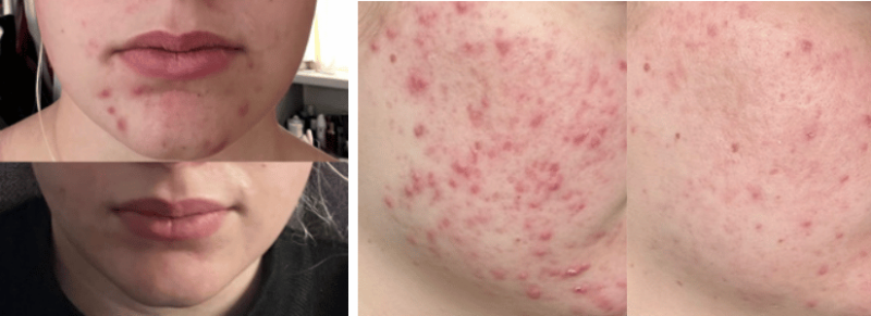 skinfixer acne