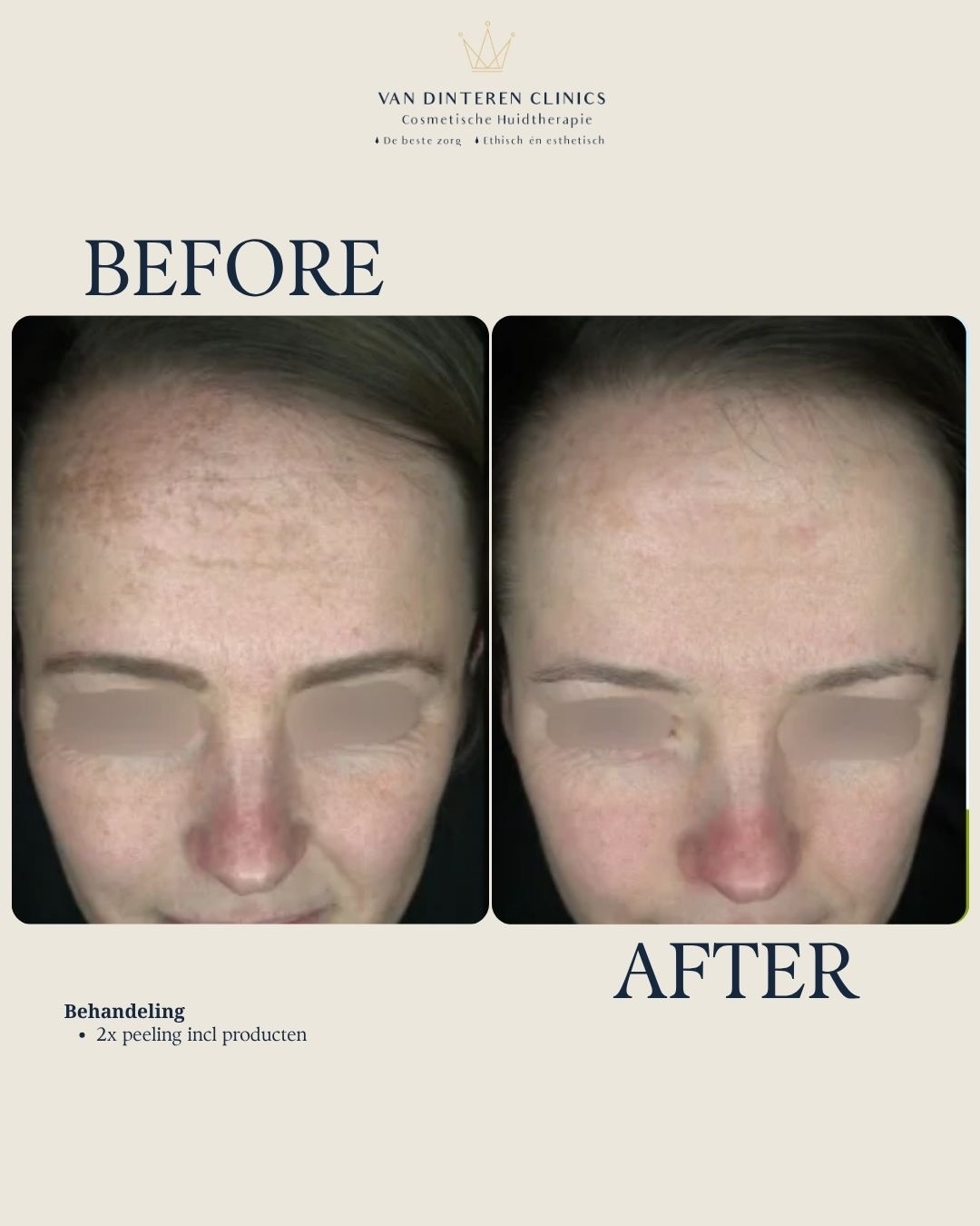 Voor en na foto melasma