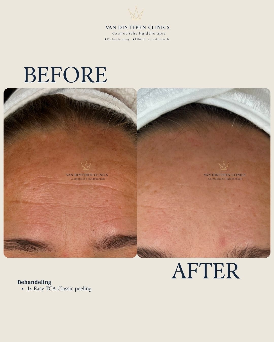 Voor en na TCA peeling