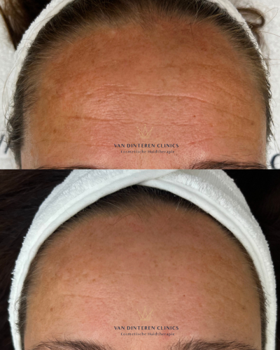 Voor en na TCA peeling Voor en na TCA peeling