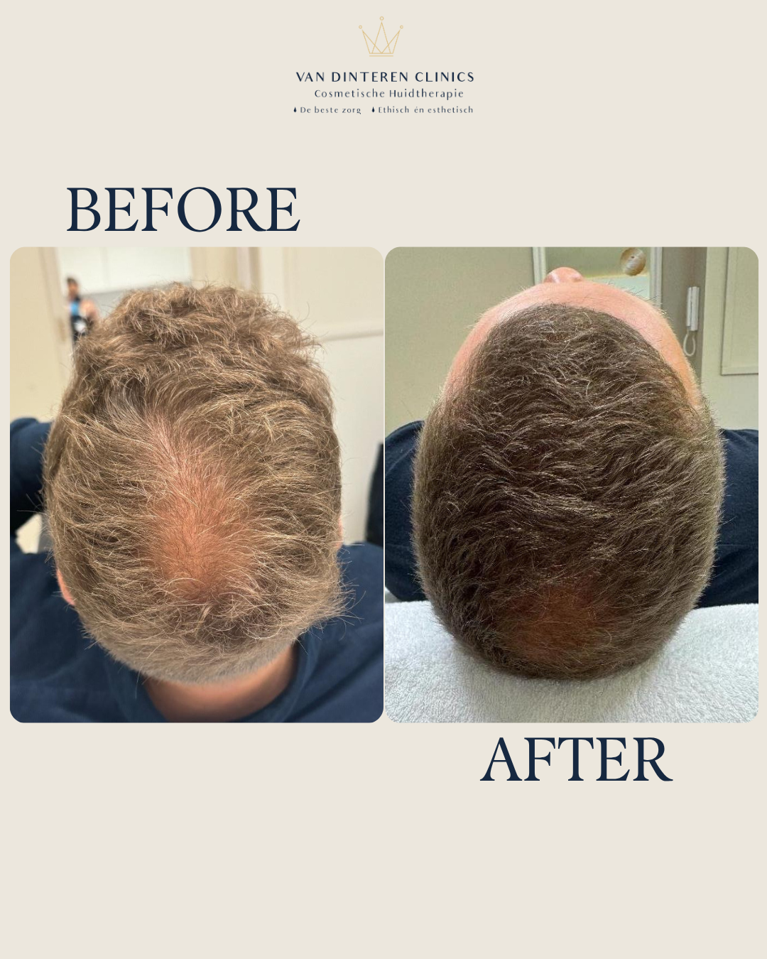Voor en na XL hair