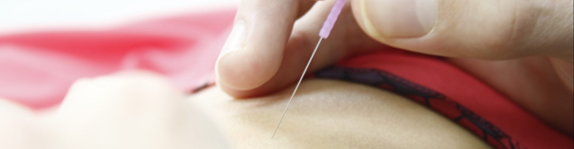 Dry needling in Bergen op Zoom en Hoogerheide Dry needling te Bergen op Zoom en Hoogerheide bij Stimulus